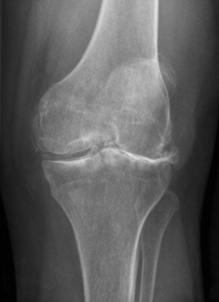 X-ray of knee joint