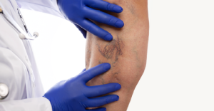 A leg with visible veins, being examined by gloved hands
