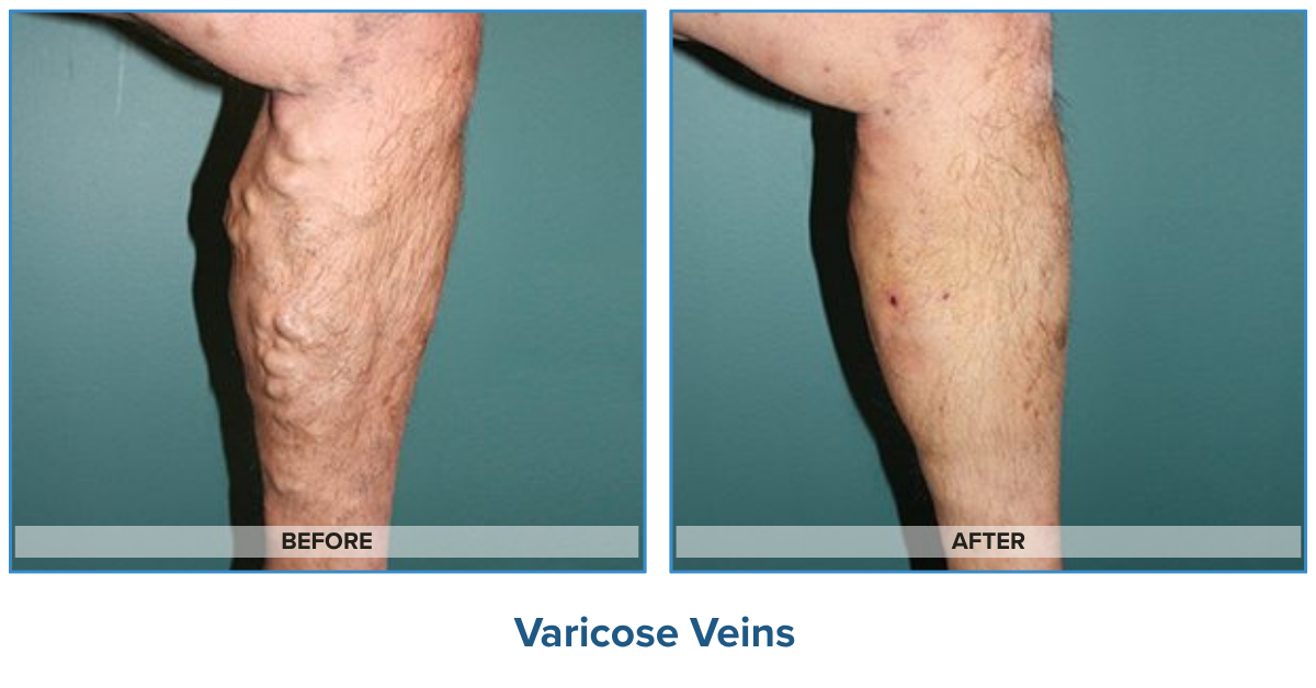 Varicose Veins Before & After