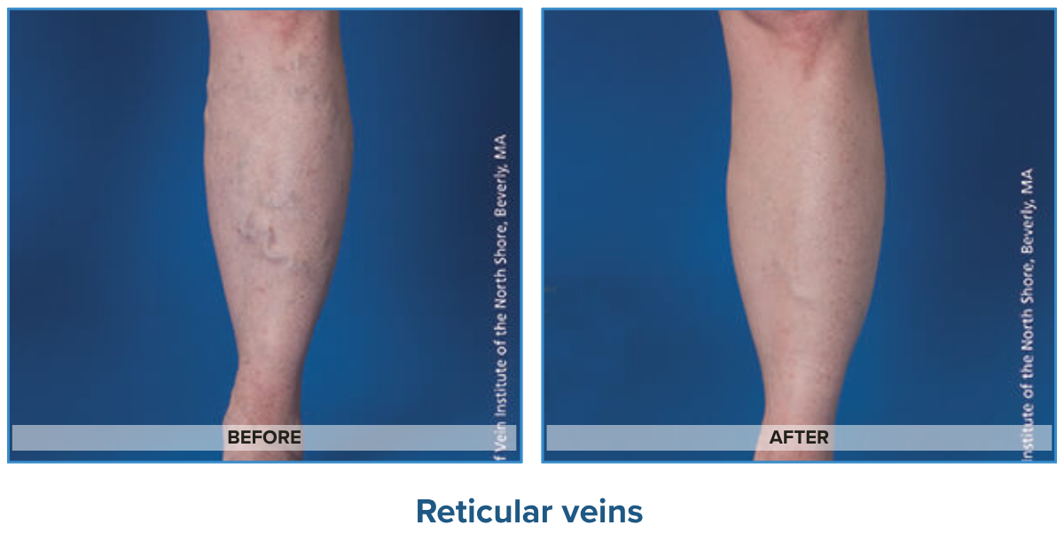 Reticular Veins Before & After