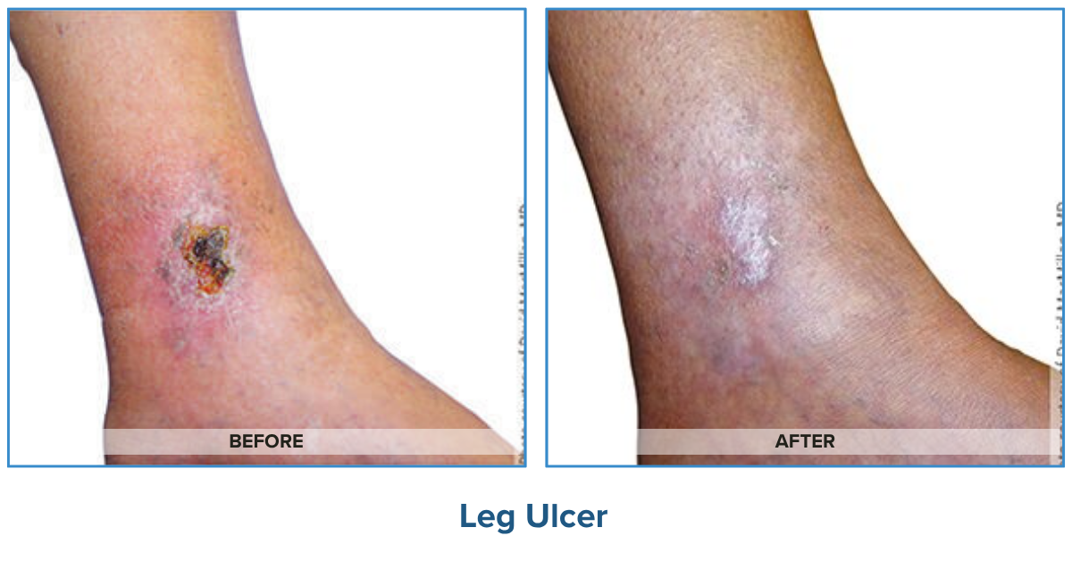 Leg Ulcer Before & After