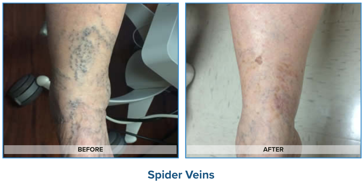 Spider Veins Before & After