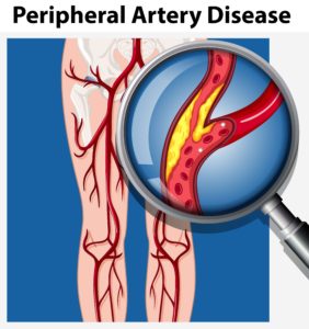a close up look of arteries blocked by PAD
